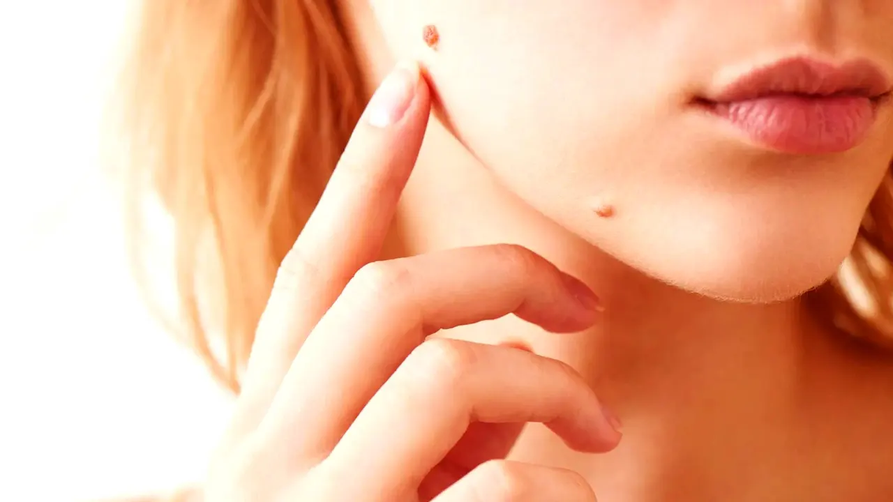 ঘরোয়া উপায়ে দূর করুন আঁচিল