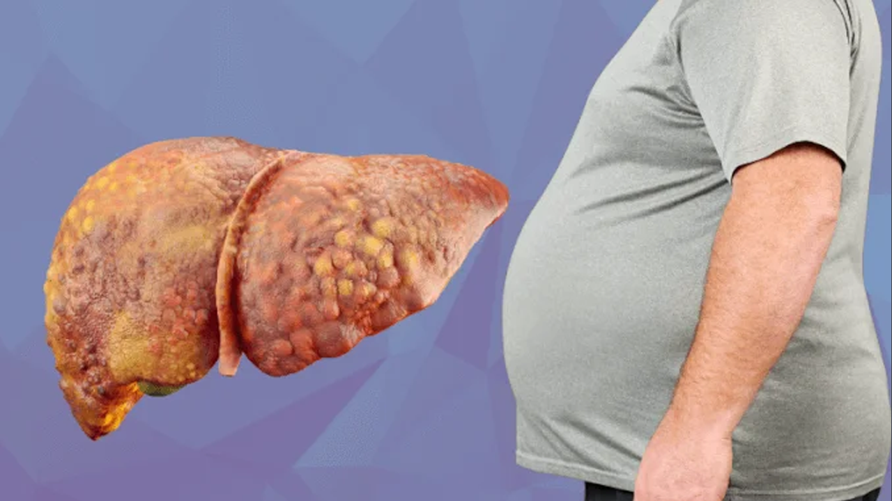মাত্র ৬০ দিনে নির্মূল হবে ফ্যাটি লিভার, খাদ্য তালিকায় রাখুন এই ৫ খাবার